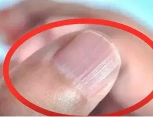 午夜三级视频廠家分析手指甲有豎紋的根本原因 午夜三级视频廠家分析手指甲有豎紋的根本原因